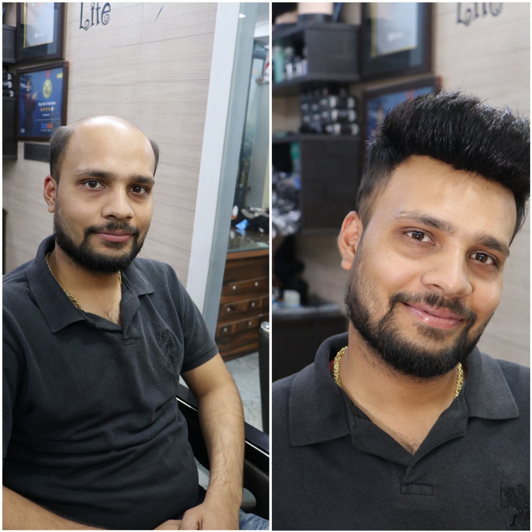 NON SURGICAL HAIR REPLACEMENT OVER HAIR TRANSPLANTS | Rizy hair Solution