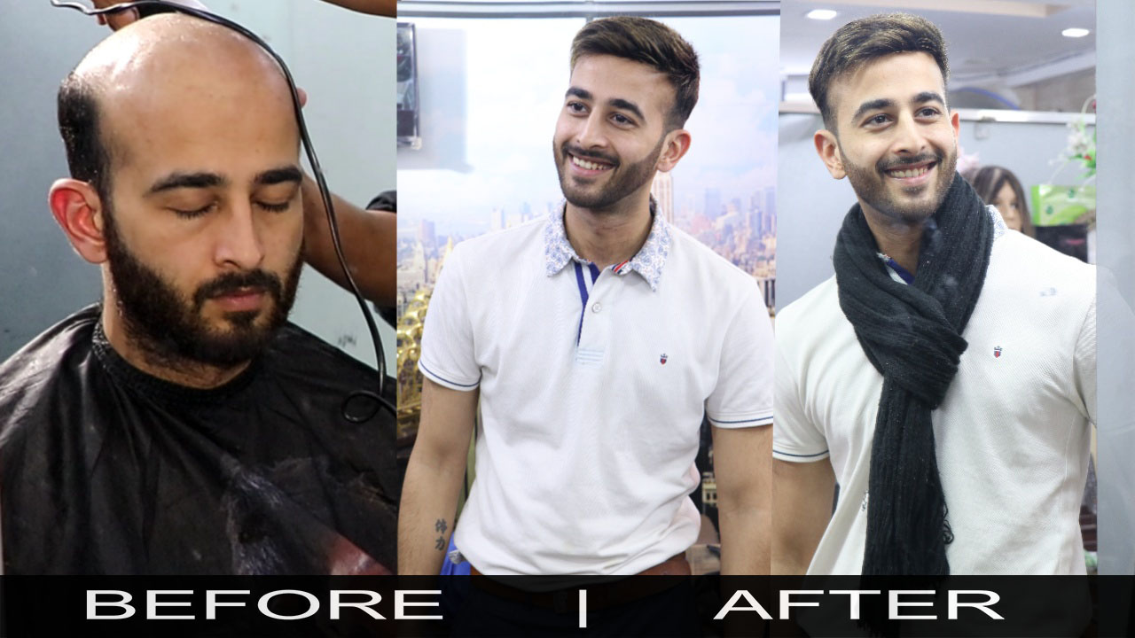 Hair Replacement For Men | Hair Patch For Men